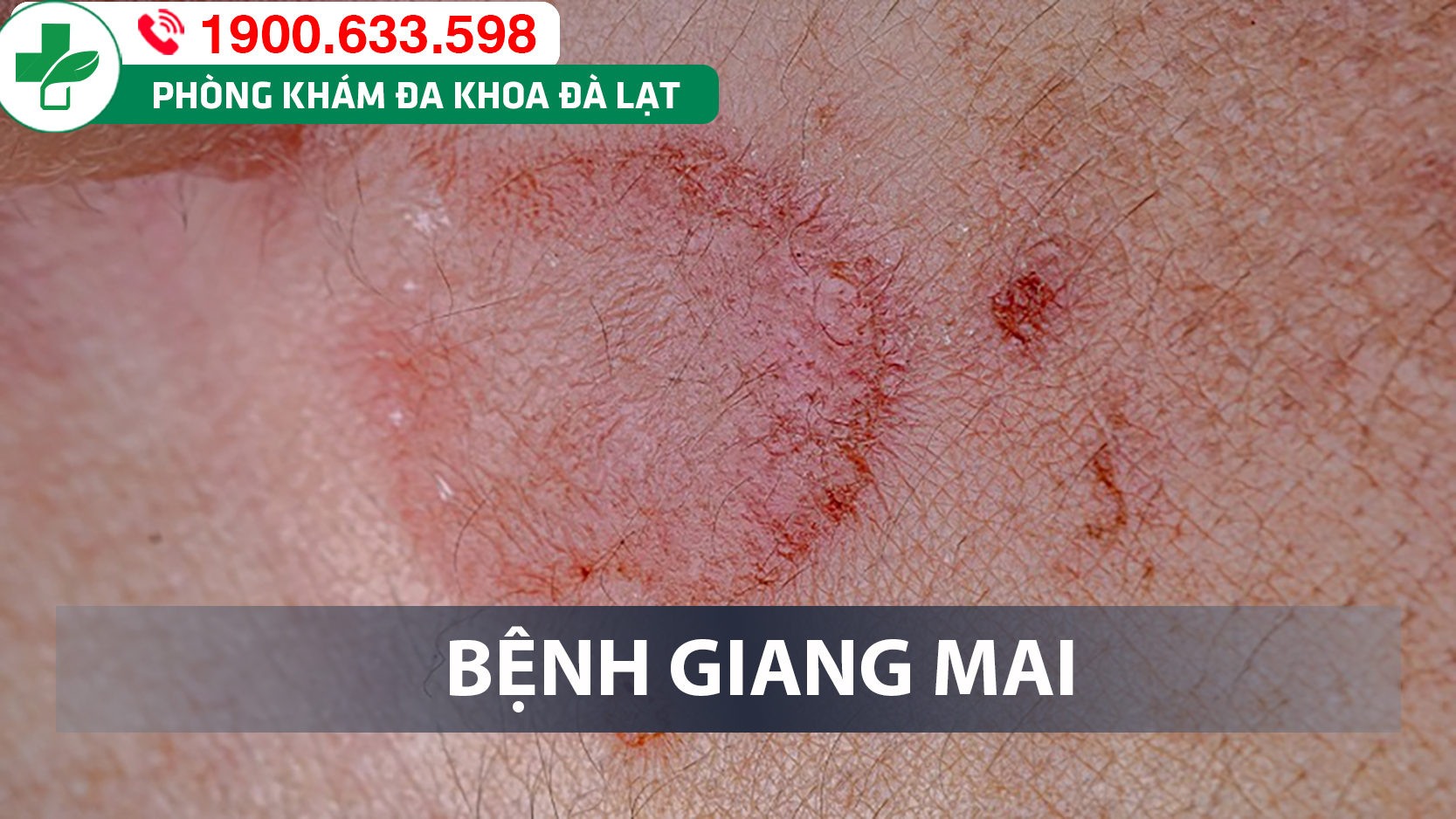 Hình ảnh minh họa